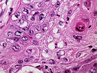 Pathway's power to boost, halt tumors may be promising cancer therapy target | Penn State University